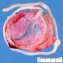 Circumvallate placenta