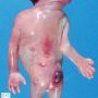 Anal imperforation, microcephaly, fetal immotility sequence