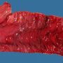 Crohn ileitis (Ileal Crohn disease)