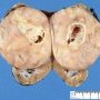 Wilms tumor