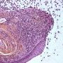 Salivary mucocele