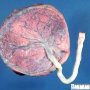 Placenta (Fetus, 17 weeks)