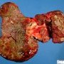 Atrophic cirrhosis in extrahepatic biliary tract atresia