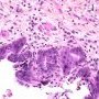 Biliary epithelial dysplasia in choledochal cyst