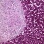 Hepatic granuloma in CVID with Mycobacterium avium infection