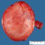 Ovarian serous cystadenoma