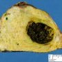 Cystic dilatation of a main bile duct in extrahepatic biliary tract (...)