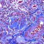 WT1-associated diffuse mesangial sclerosis