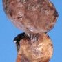 Pleuropulmonary blastoma type 1