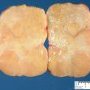 Ovarian fibrothecoma