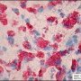 Portal lipid-laden macrophages in CESD-Wolman disease