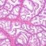 Clear Cell Cribriform Hyperplasia