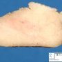 Lower limb lipoma