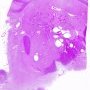 Cerebral pneumatosis in septicemia
