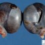 Hemorrhagic necrosis of the testis after torsion