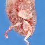 Unique obstructive right kidney with left renal agenesis