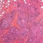 Pulmonary nodular lymphoid hyperplasia