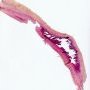 Aortic dissection in Marfan disease