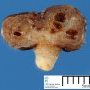 Colonic juvenile polyp