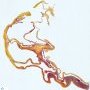 Splenic multilocular mesothelial cysts