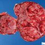 Bilobar placenta with central insertion of the umbilical cord