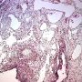 Pleuropulmonary blastoma type 1
