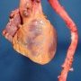 Aortic dissection in Marfan disease