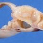Ovarian cystic juvenile granulosa tumor