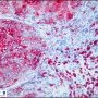 Portal macrophagic infiltration in Wolman disease-CESD