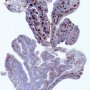 BCL2 immunostaining in adenoid