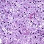 Lipofuscin in Kuppfer cells