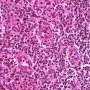 Acute inflammation with granulocytic diapedesis in ileal Crohn (...)