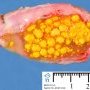 Cholelithiasis