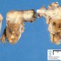 Multiple testicular adenomas in androgen insentivity syndrome
