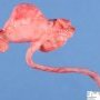 Ileal duplication cyst