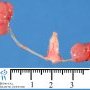 Right simple renal ectopia with renal hypoplasia