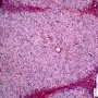 Perilobular fibrosis