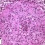 Epitheloid cells in epithelioid granuloma (chalazion)