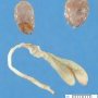 Bifid uterus, rectogenital fistula, rectal atresia, urinary (...)