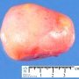 Ovarian dermoid cyst