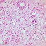 Invasive lobular carcinoma of the breast (Credit Ed Uthman)