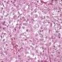 Large round tumoral cells in malignant rhabdoid tumor