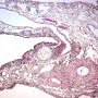 Pleuropulmonary blastoma type 1