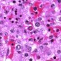 Parvoviral inclusion in fetal liver (hydrops fetalis)
