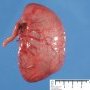colonic atresia