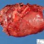 Abdominal cystic lymphangioma