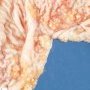 Borderline serous ovarian cystadenoma