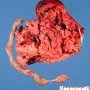 Umbilical cord stricture with fetal death