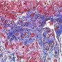 Portal fibrosis and biliary ductular proliferation in juvenile (...)