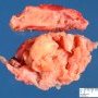 Thymic seminoma